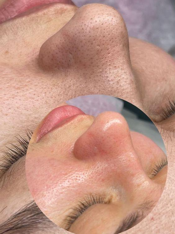 face treatment