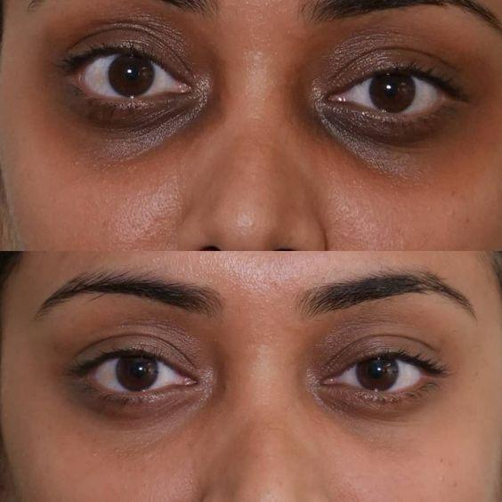 under eye treatment